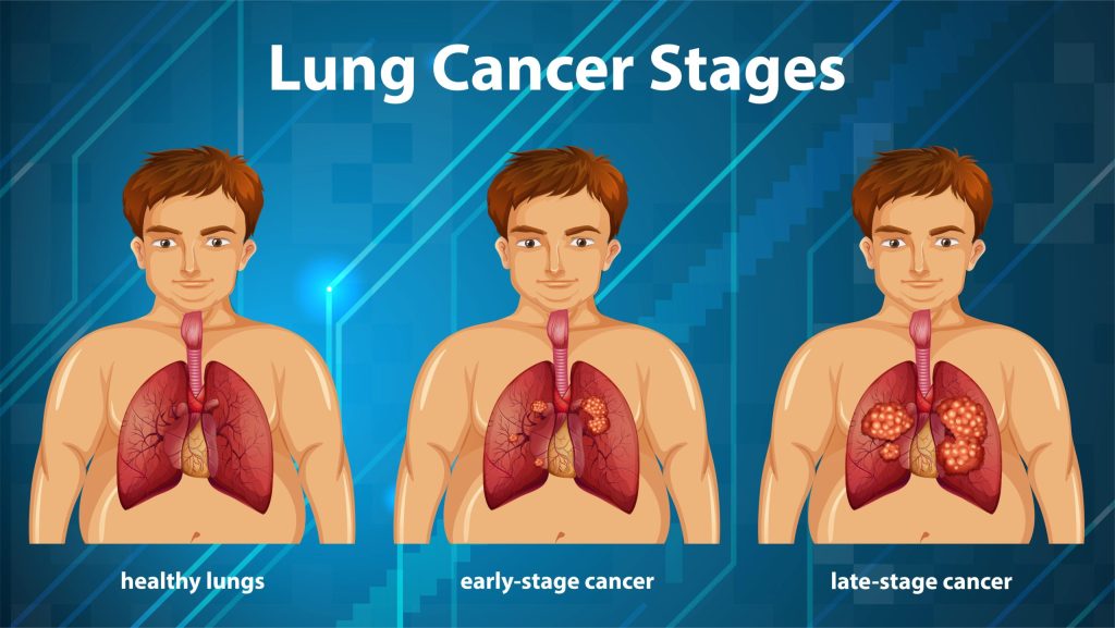 stages of lung cancer