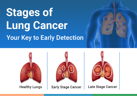 stages of lung cancer